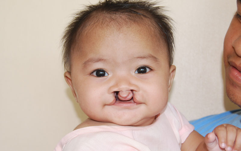 Bilateral cleft lip and palate Bilateral cleft lip and palate