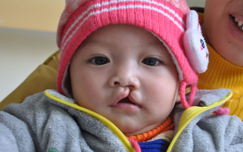 Simple cleft lip Simple cleft lip