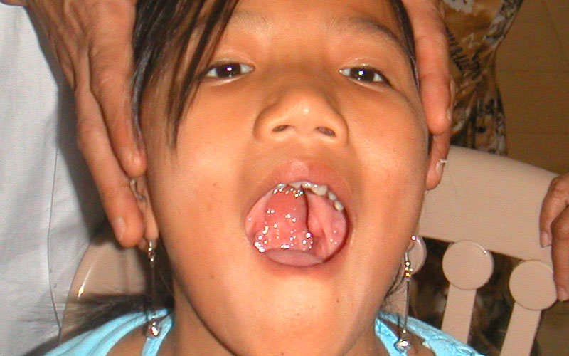 Cleft palate Cleft palate