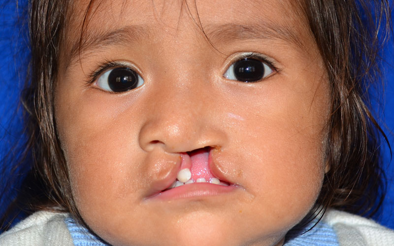 Left-hand lip and maxilla cleft Left-hand lip and maxilla cleft