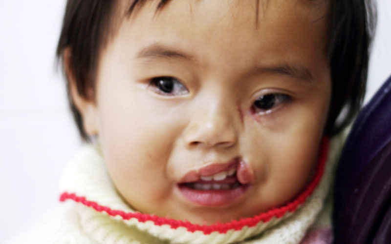Transverse cranio-facial cleft with partial loss of eye Transverse cranio-facial cleft with partial loss of eye