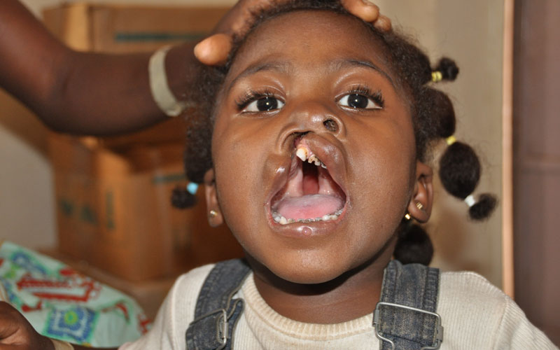 Full cleft of lip and maxilla Full cleft of lip and maxilla